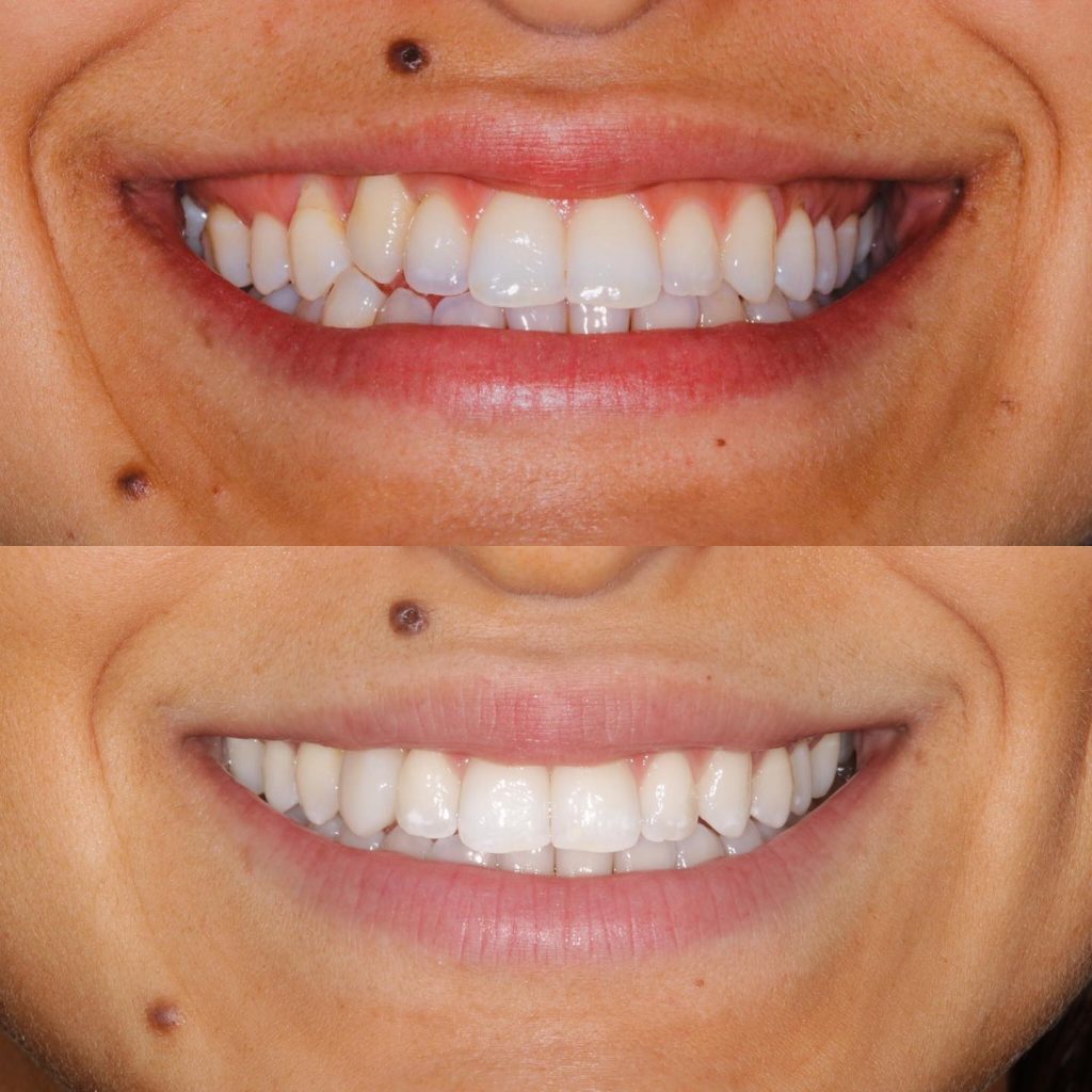 Invisalign before and after photo